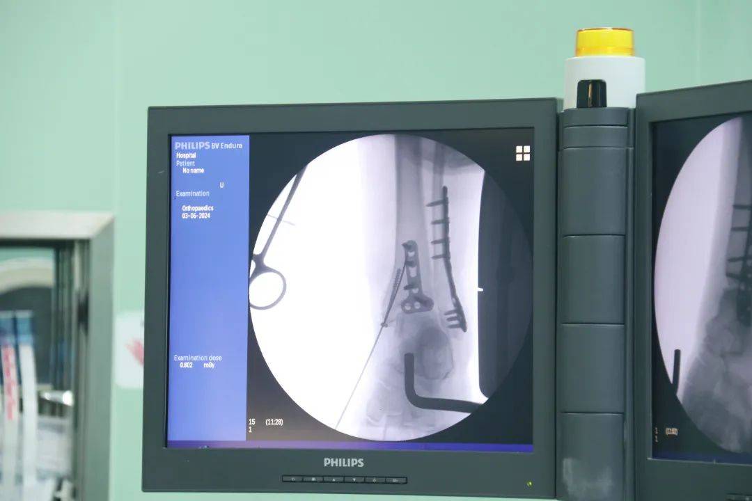 lau教授来到手术室,与我院骨科手术团队共同实施复杂踝关节骨折手术