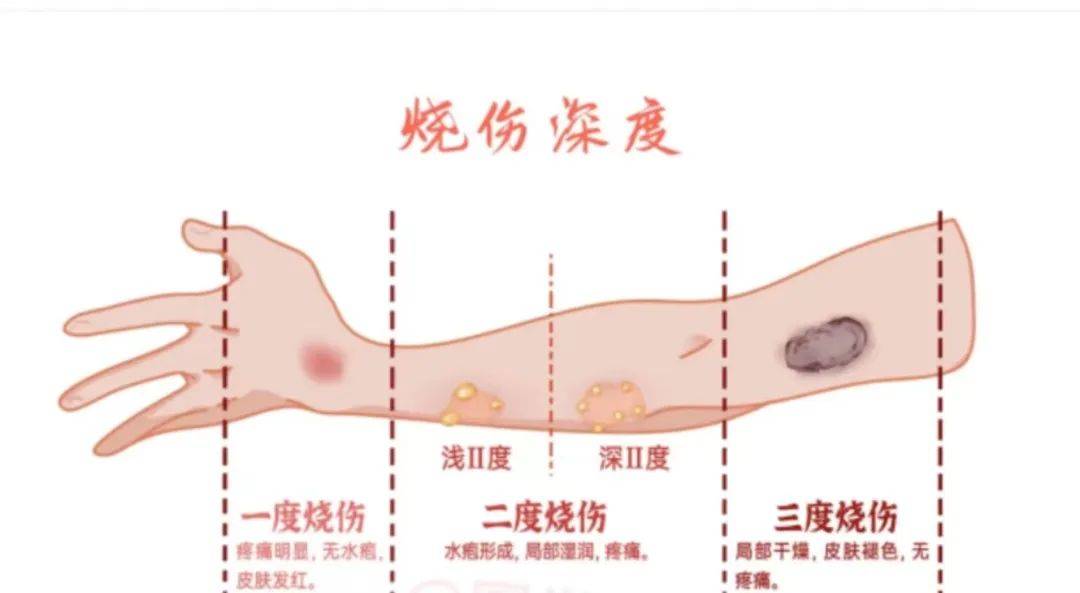 烧伤烫伤卡通图片