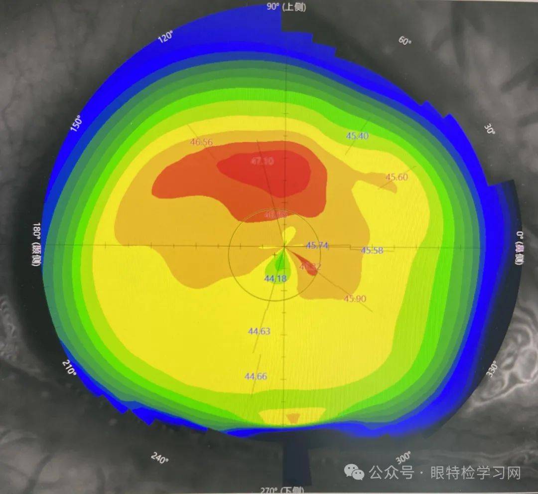 角膜地形图高度图分析图片