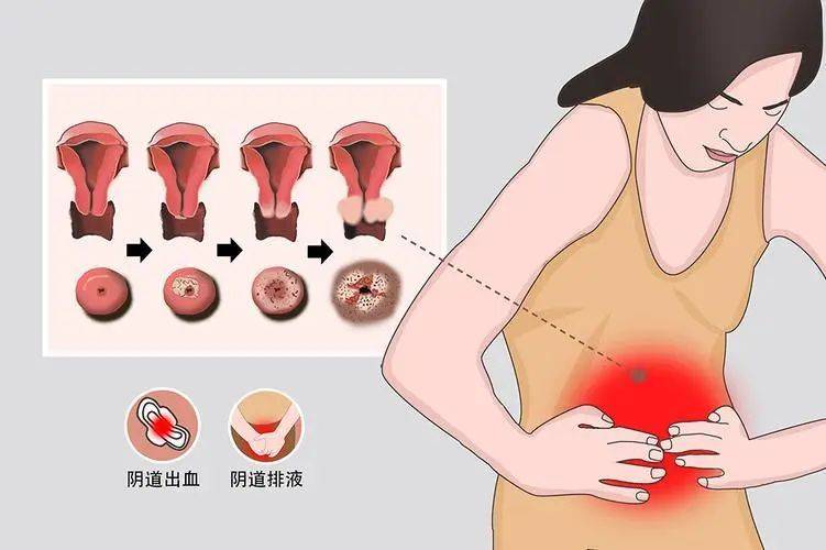 最常见的症状就是阴道出现不正常的分泌物,多为血性的液体或者浆液性