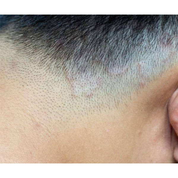 头皮问题产生原因如下:头皮屑和头痒通常是由多种原因引起的