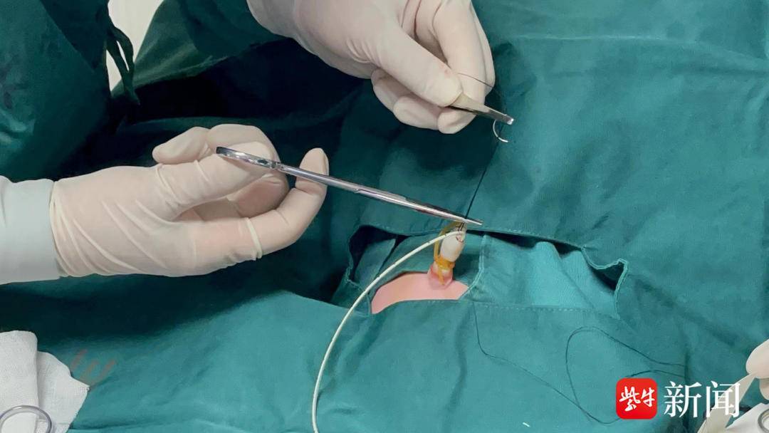 对口帮扶带去"脐静脉置管技术",江大附院儿科护士长为泗阳危重新生儿