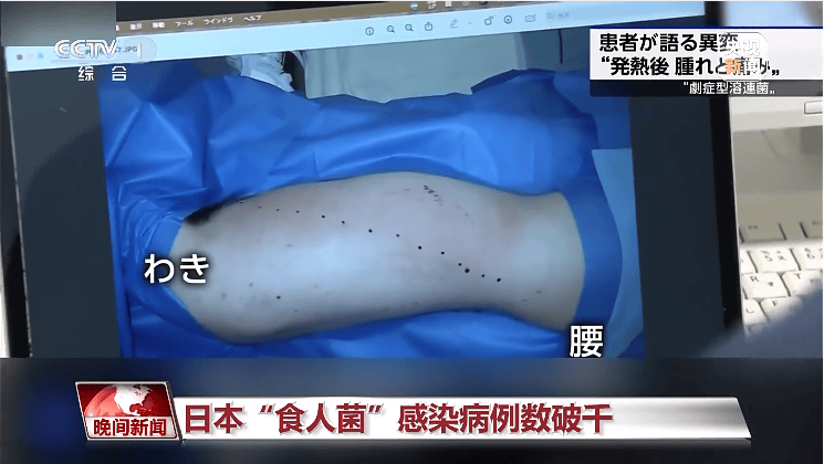 感染后48小时可致命!症状似感冒!通过接触和飞沫传播