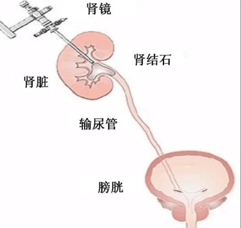 我院成功开展一例经皮肾镜肾结石钬激光碎石取石术
