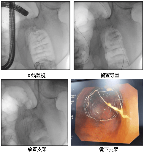 肠梗阻支架图片