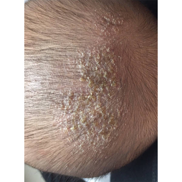 毛囊炎用什么洗发水好用?去头屑最好的洗发水推荐