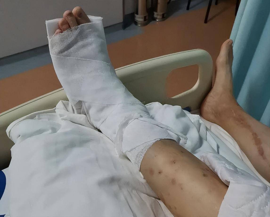 为什么老人身体好好的,摔一跤没多久就走了?