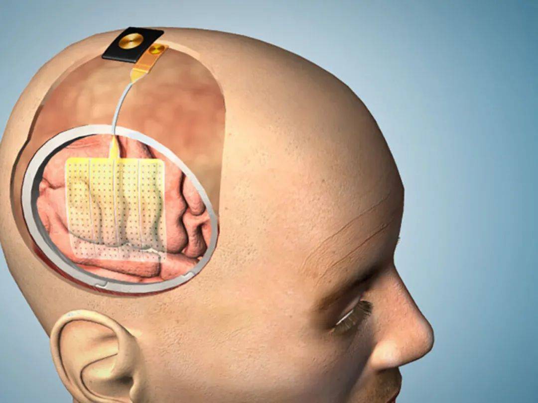 技术动态 | UCSD研发术中脑功能成像技术 分辨率提高了100倍