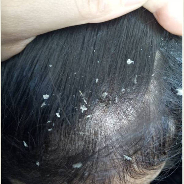 比如在约会时,蓬头垢面的头皮屑会让人感到尴尬和不自信;在工作场合