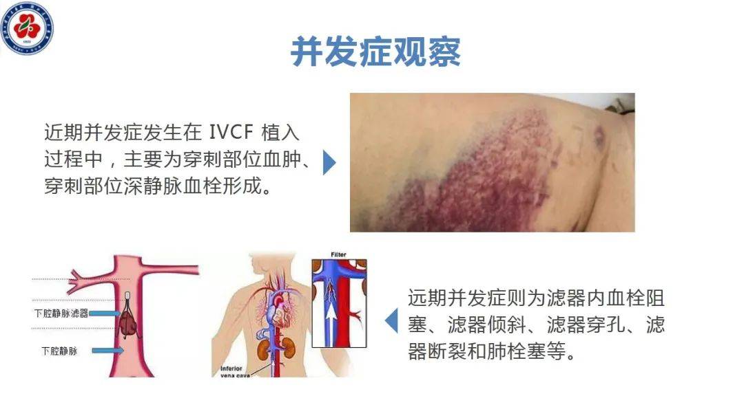 下腔静脉滤器置入术图片