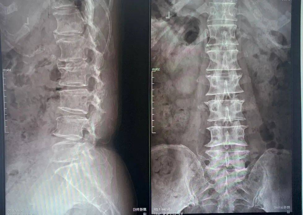 非遗传承五步法整复腰椎 丨上海市中医特色专病专科(社区)专栏