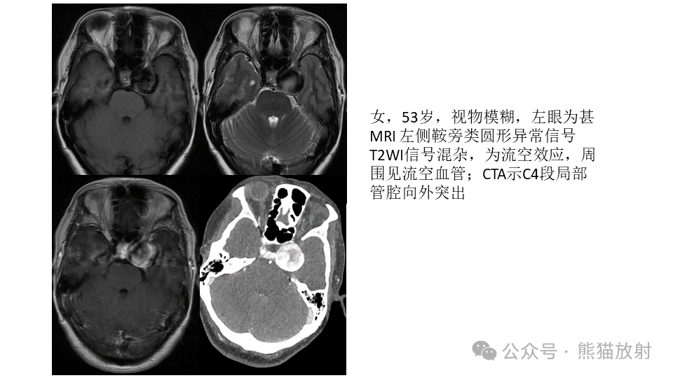 鞍区肿瘤PPT图片