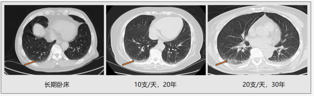 吸烟的危害:有图有真相,看看吸烟者的肺吧!