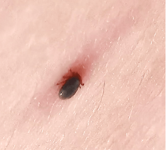 被蜱虫叮咬,轻则出现一个小破口,周围有些红肿,充血,不适.