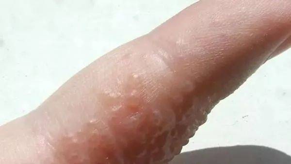 好痒好痒好痒!这些"小水泡"为什么这么针对我?