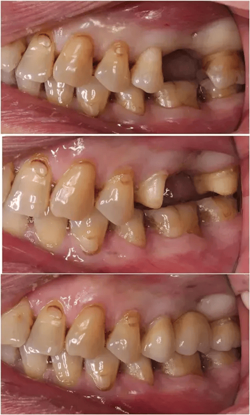 缺失的牙齿的两侧或一侧牙磨小用作基台(桩),以制作牙桥修复体(连接在