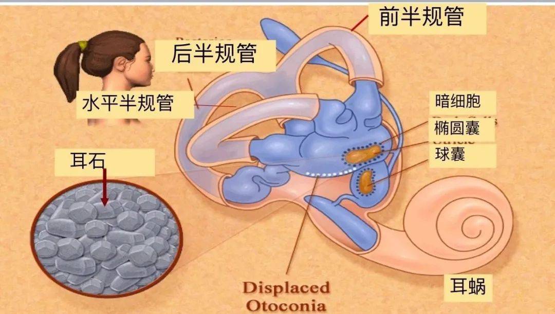 天旋地转?竟是耳石症在作怪