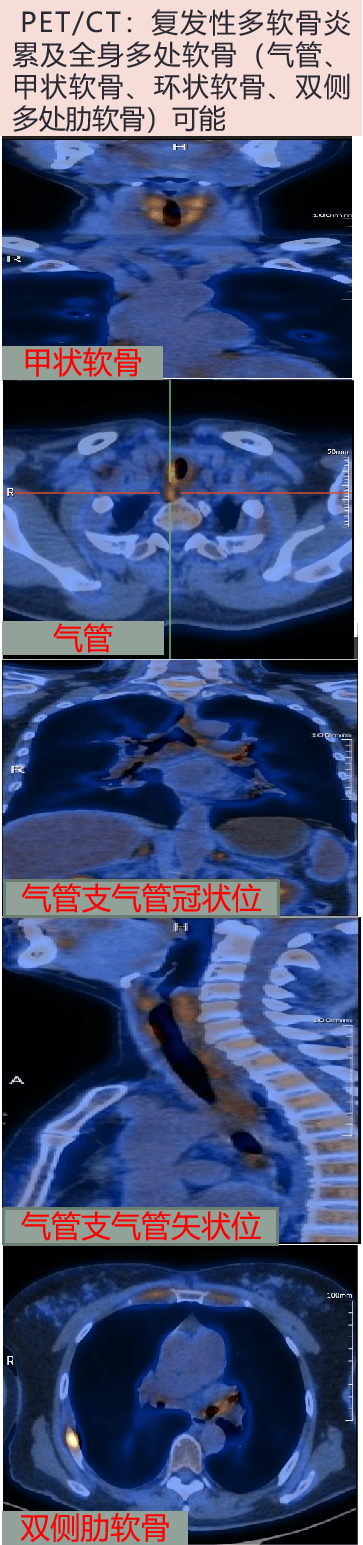 支气管_阴性_病史