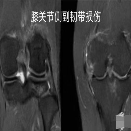 患者在尝试下蹲时,由于韧带的损伤和疼痛,可能会感到关节不稳定,从而