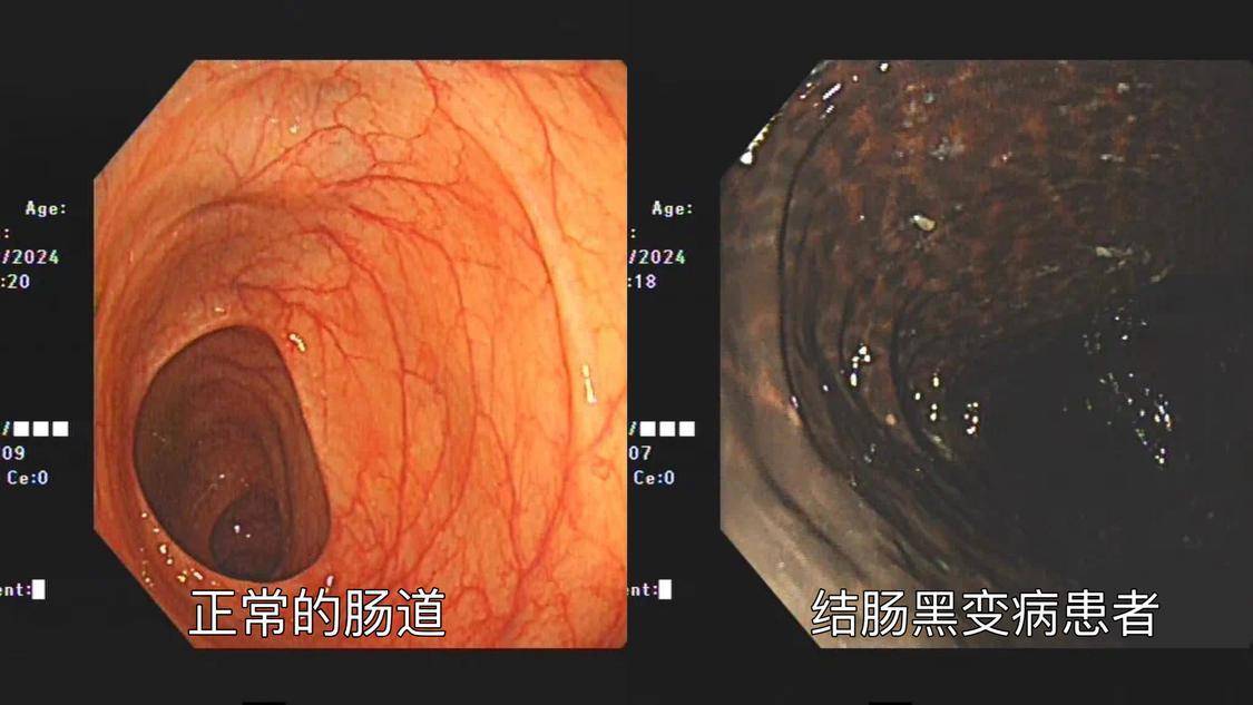 佛山市南海区人民医院胃肠外科主任张晓槟解释,在临床上,结肠黑变病并