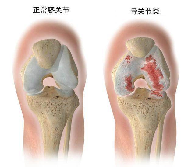 膑骨关节炎图片