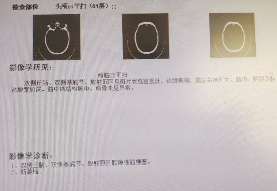 头颅ct:双侧丘脑,双侧基底节,放射冠区腔隙性脑梗塞,脑萎缩心电图:窦