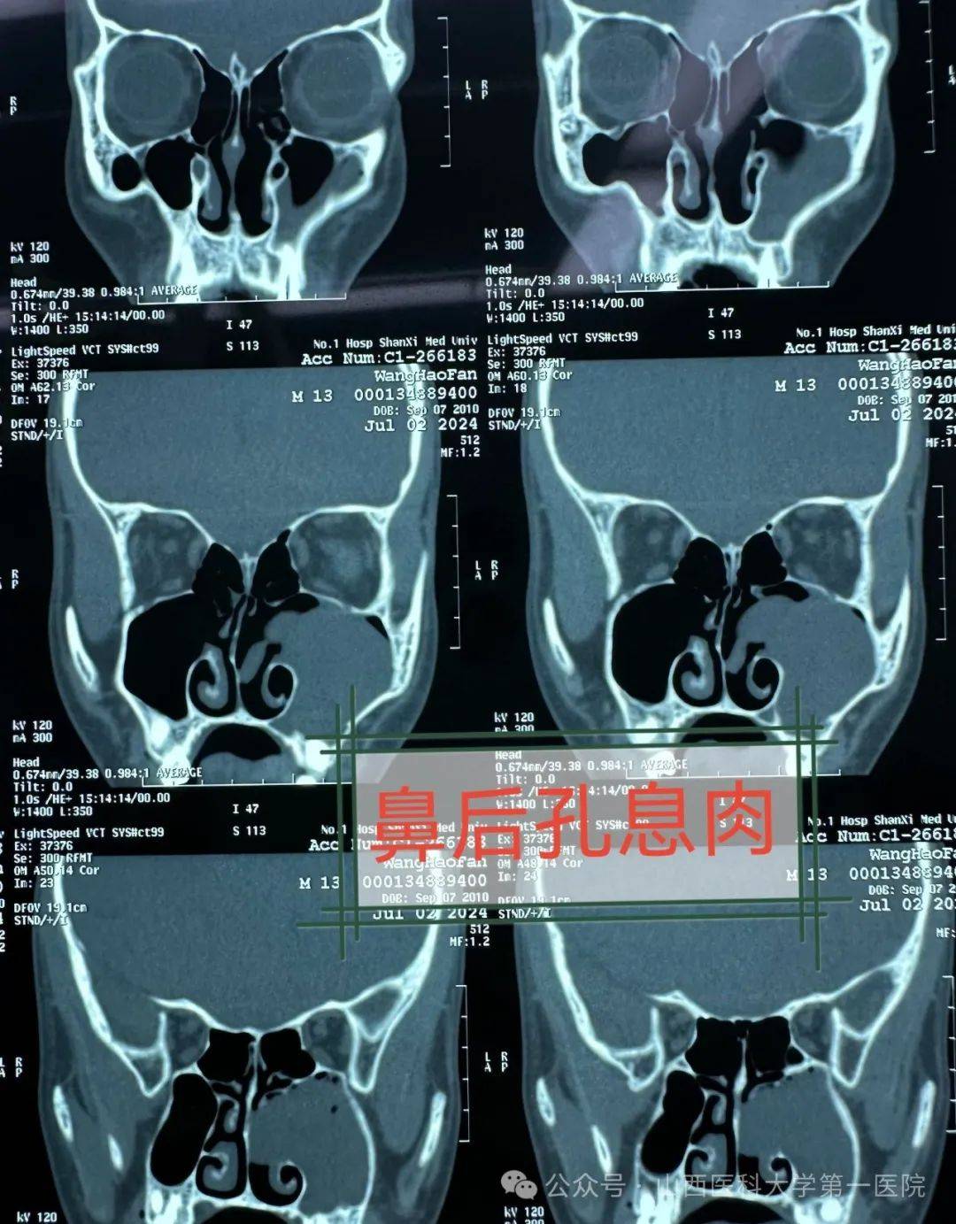 小孩鼻子割掉的图片图片