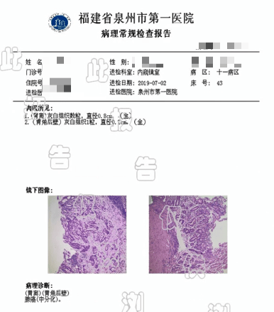 胃癌检查报告图片晚期图片