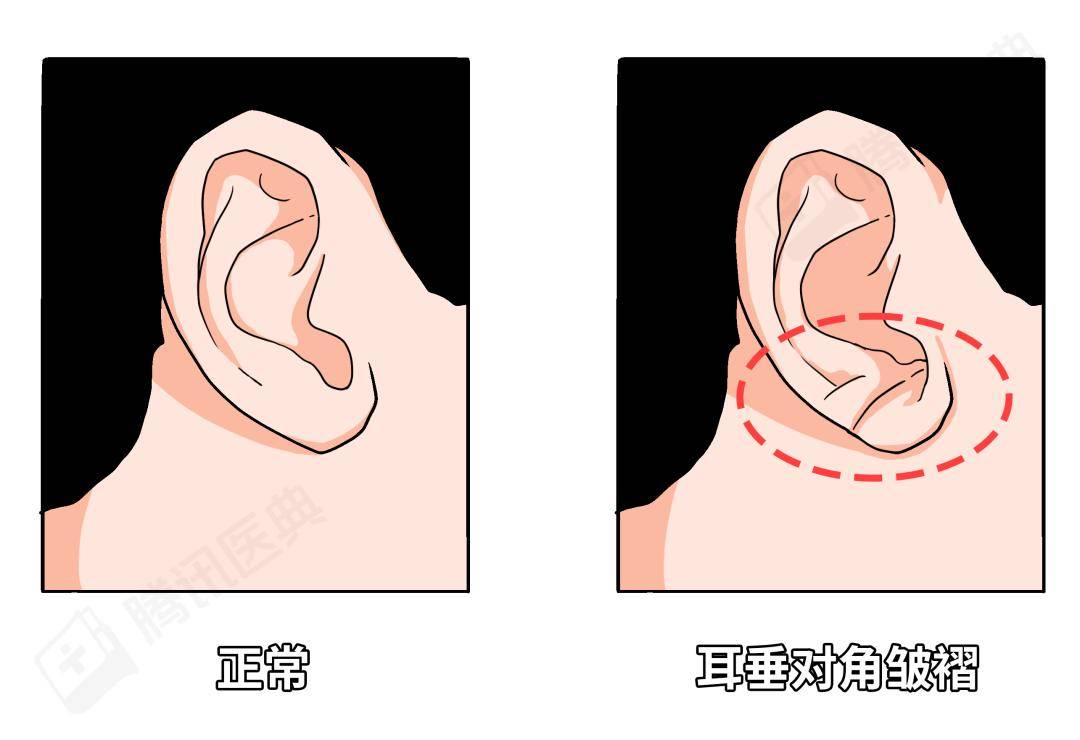 耳垂内卷面相图片