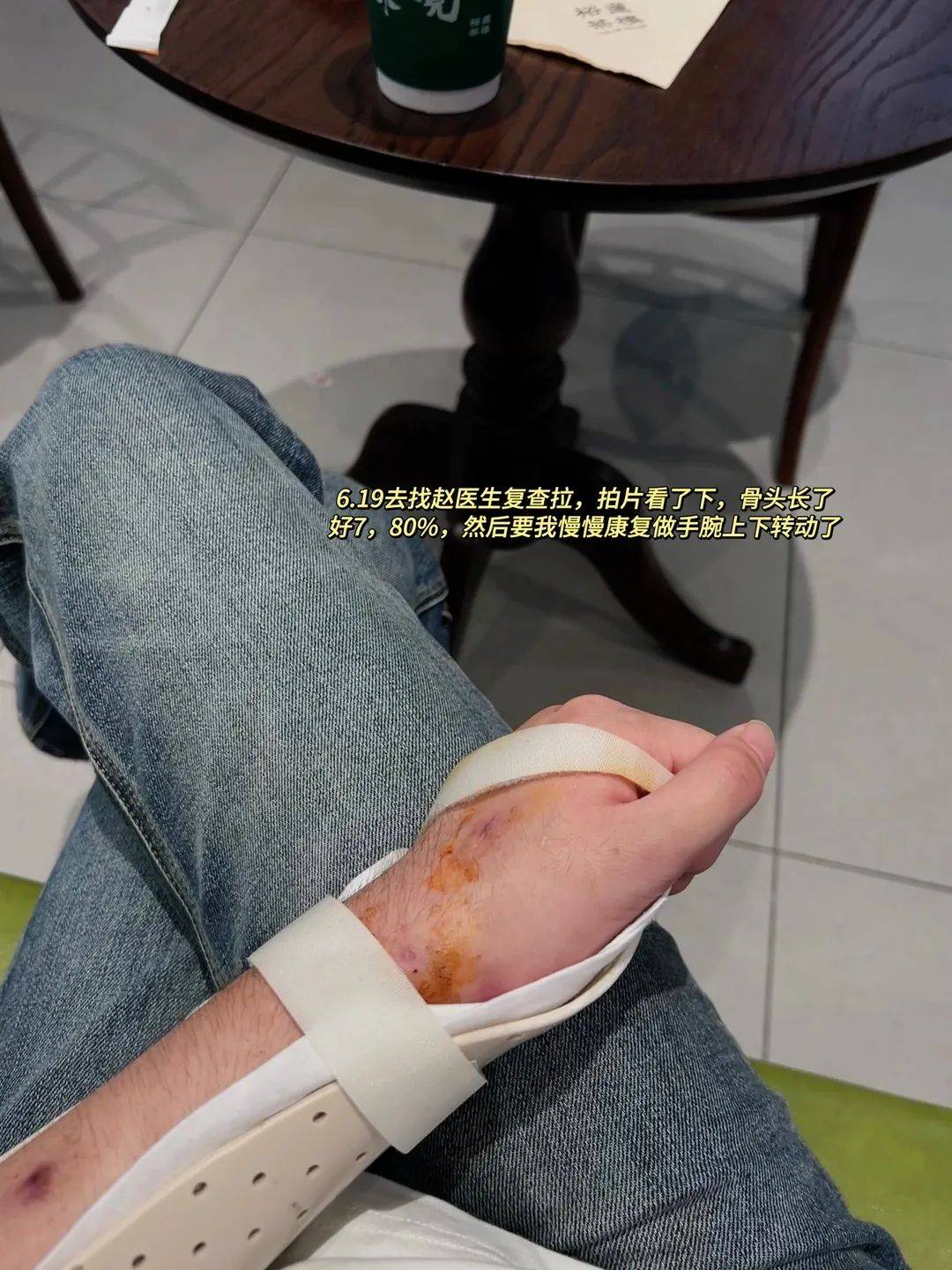 萧山姑娘骑自行车发生意外,人生第一次上手术台!怎么摔成这样?