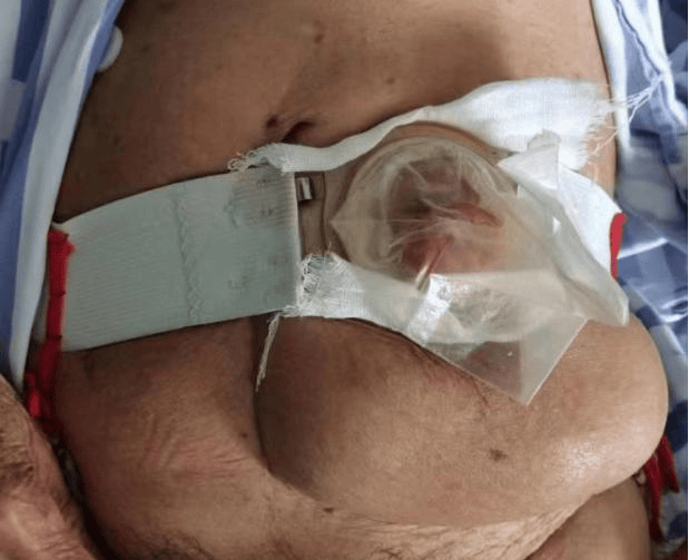 【技术突破】德化县医院完成首例巨大造口旁疝修补术(sugarbaker)