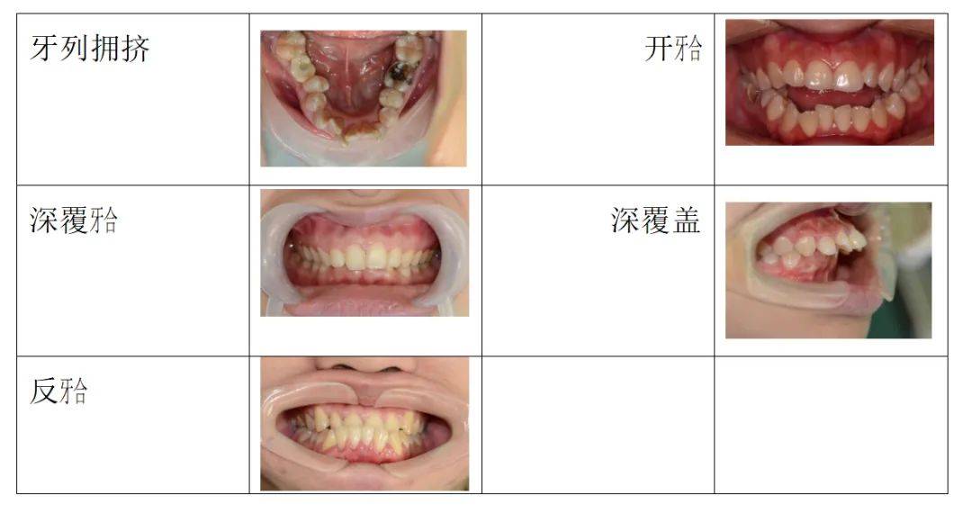 正常人牙齿闭合图片