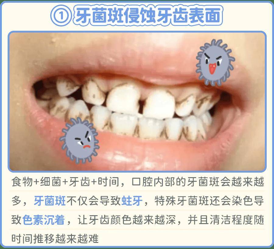 如果蛀牙,一般还有这两个原因——牙齿发黄发黑,有时候是因为吃多了高