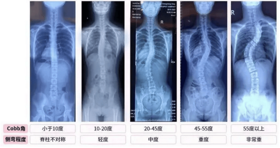 脊柱x线平片显示脊柱有大于10°的侧方弯曲