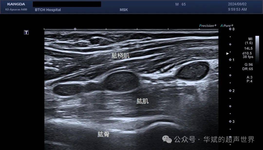 典型病例61(桡神经)丛型神经纤维瘤