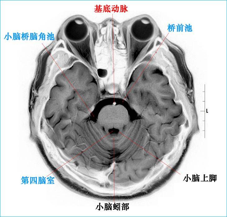 脑干mri断层解剖图图片