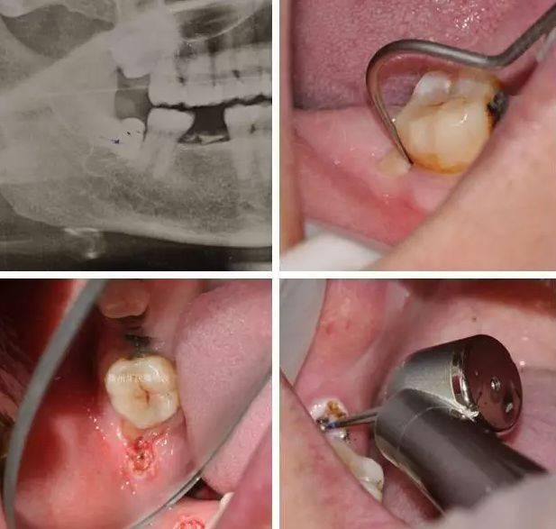 拔尽头牙过程图片