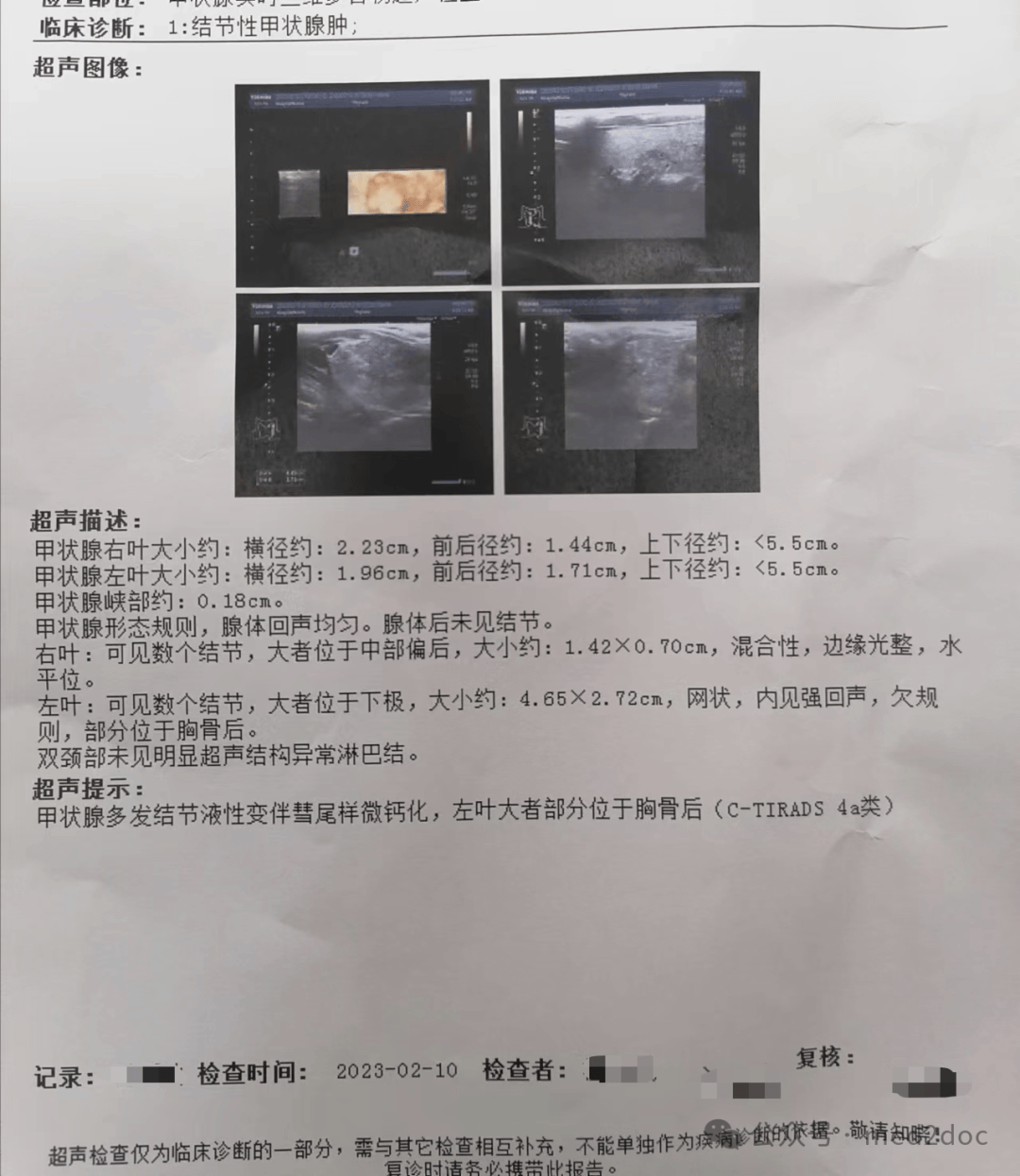 一院检查,被告知右侧结节虽然小但是多,左侧结节大且充满整个甲状腺
