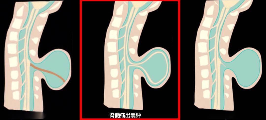 凌锋基金会与宣武医院神经外科团队救治一例严重脊髓脊膜膨出患儿