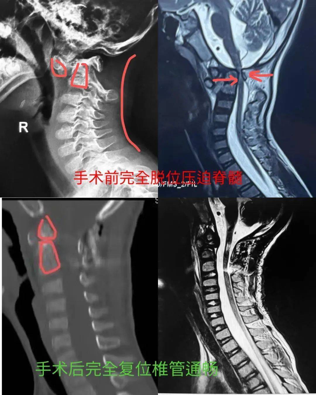 寰椎椎弓骨折图片