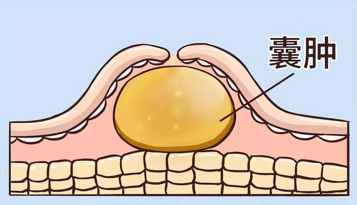 中成药治疗囊肿，为什么效果都很一般？老中医正面回答，不惧质疑