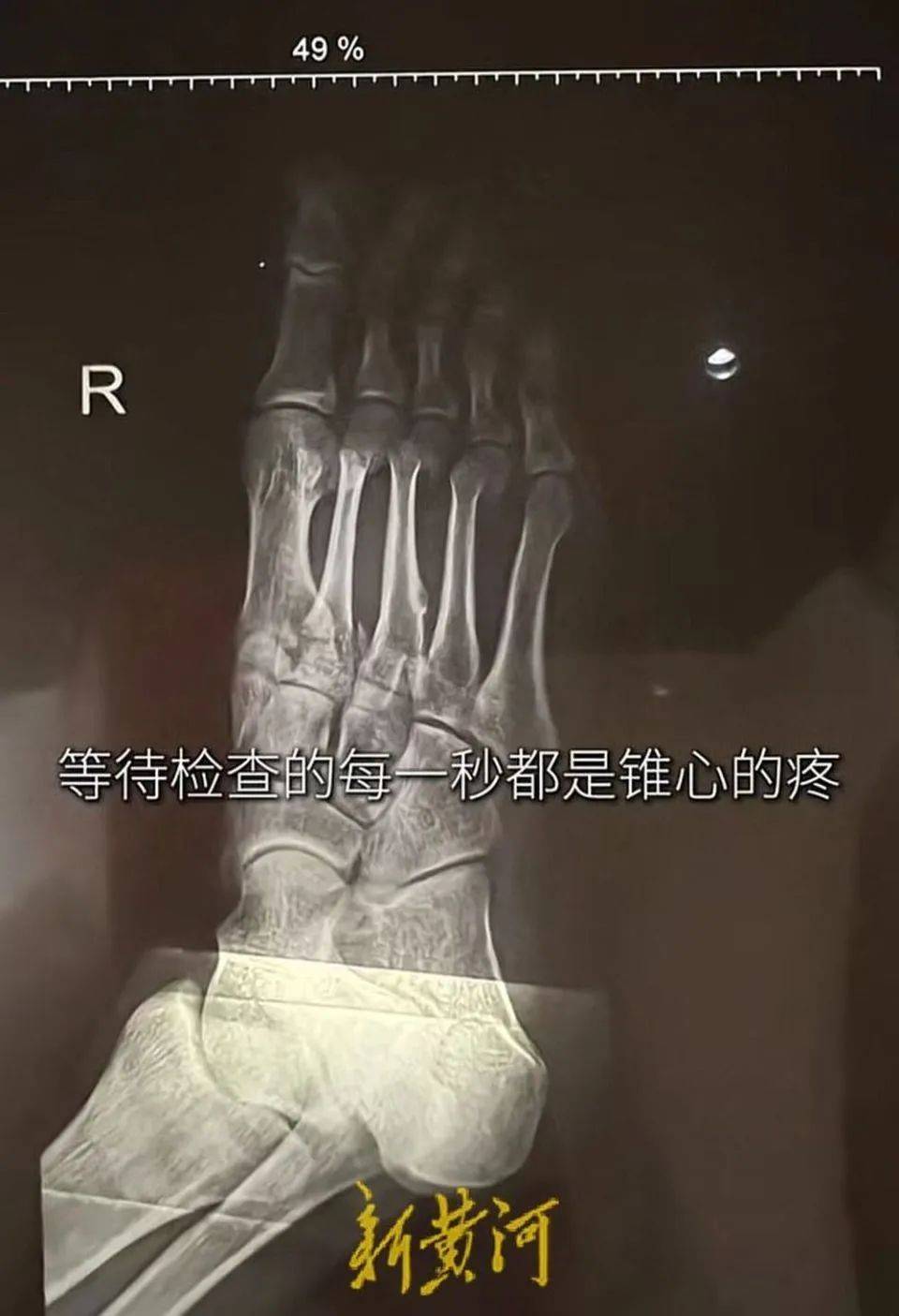 男子乘酒店电梯疑坠梯 致右脚多处骨折