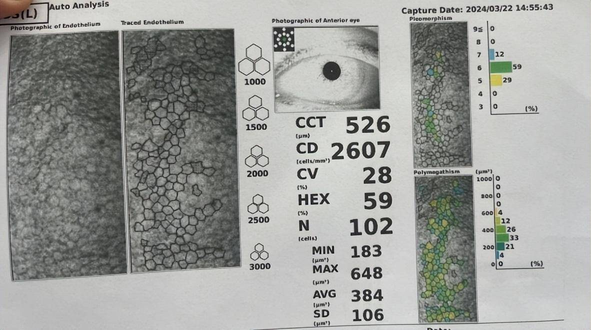 经详细检查,科室主任张慧发现其外伤引起,角膜受损,内皮异常,晶状体