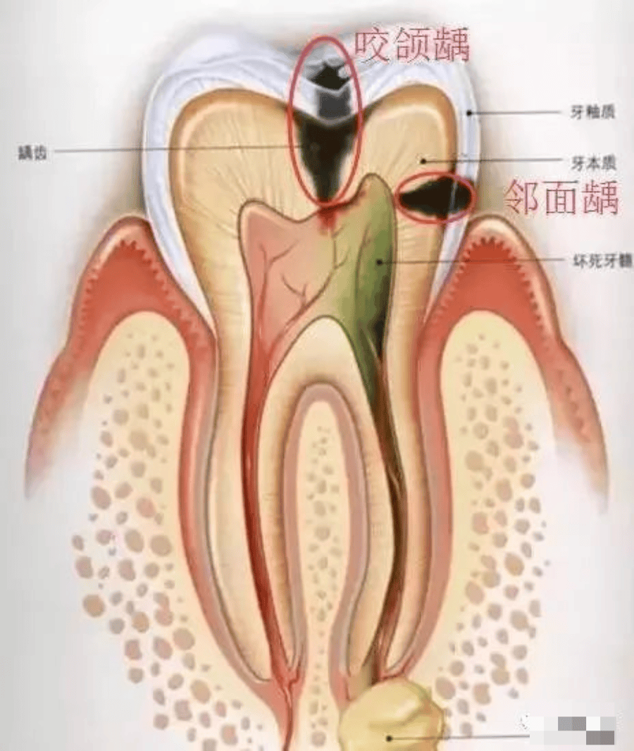 门牙龋齿牙缝图片