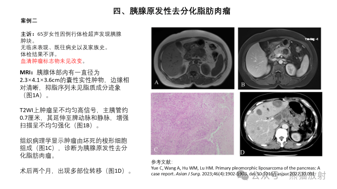 胰腺结节图片