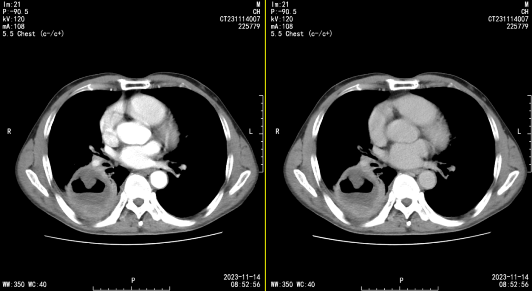 让人匪夷所思的「肺脓肿」,并非你所想_病灶_影像_复查