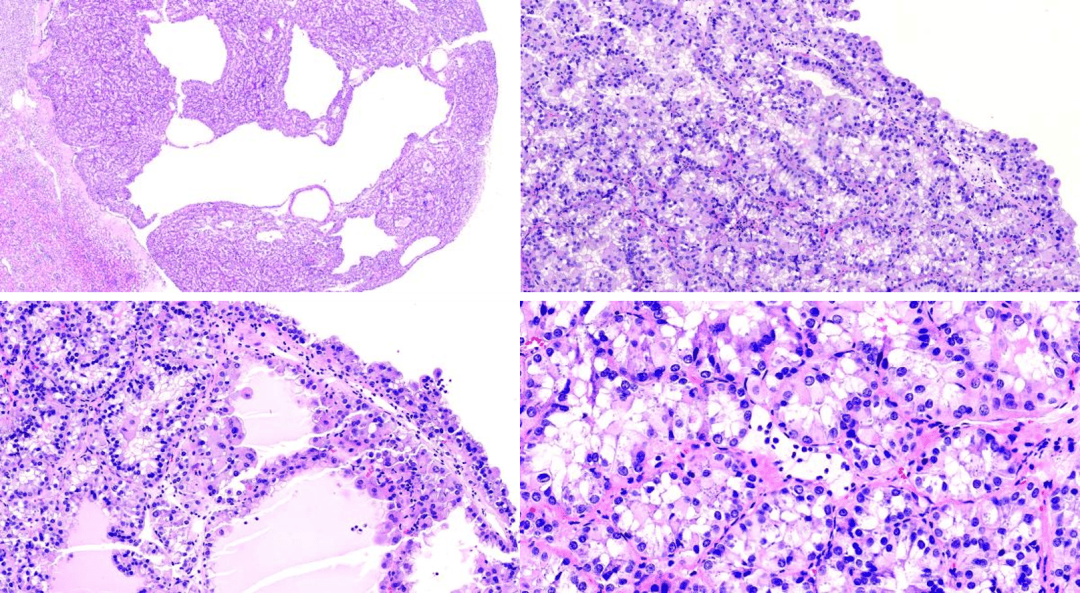病例精讲 | 嗜酸性实性囊性肾细胞癌（ESC RCC）一例(图2)