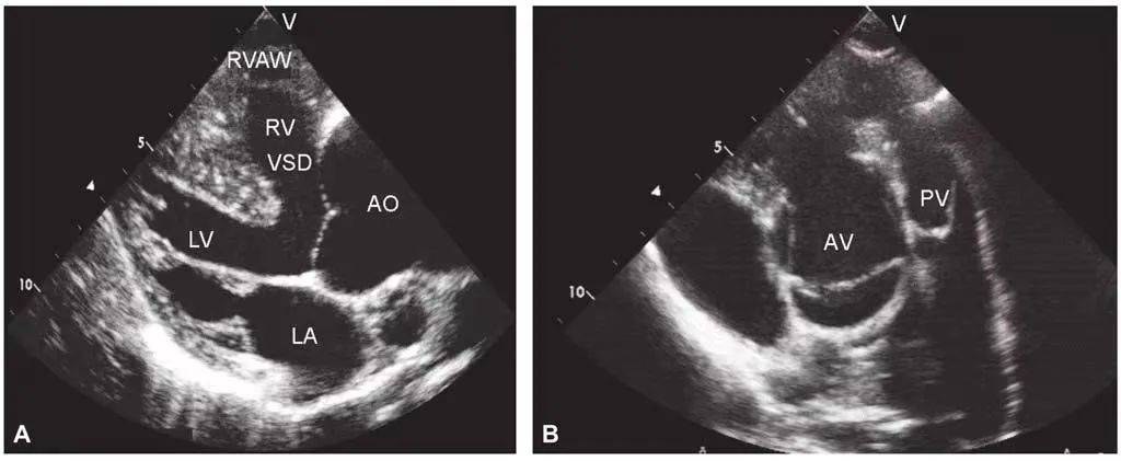 是联合的先天性心脏血管畸形,包括肺动脉口狭窄,心室间隔缺损,主动脉