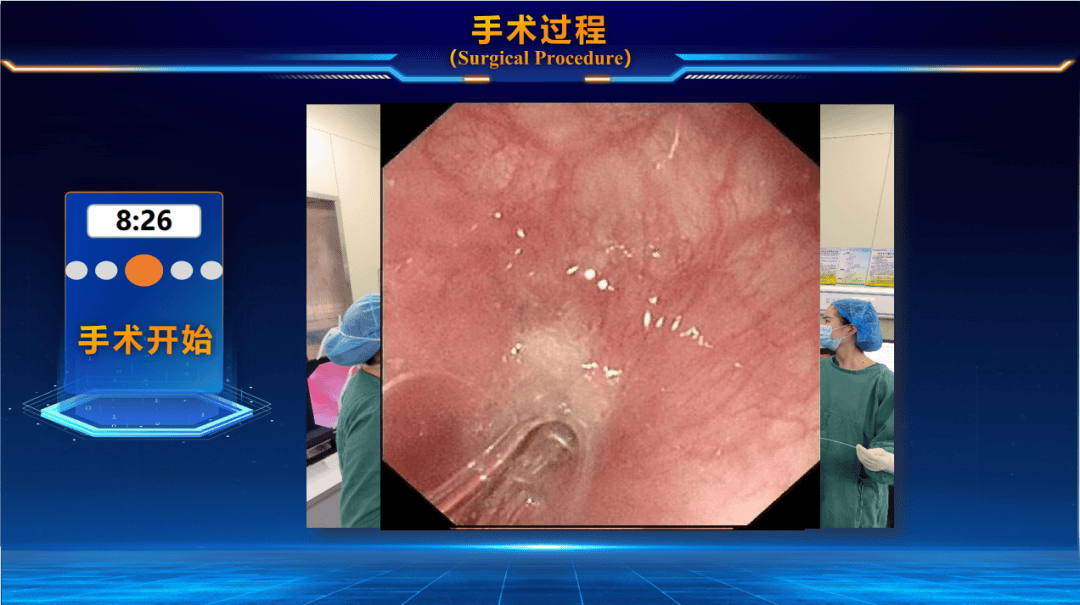 苯磺酸瑞马唑仑在小儿食道狭窄球囊扩张术中的应用——醉佳cp舒适化诊