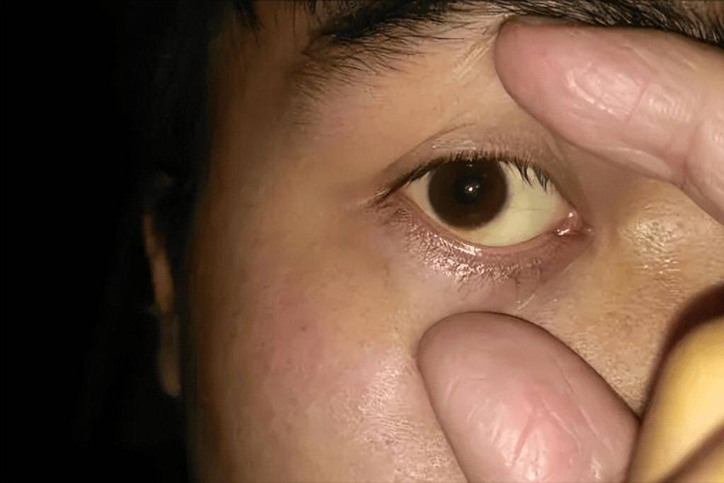 肝脏好不好看眼睛就知提醒肝脏差的人眼睛一般有这些现象